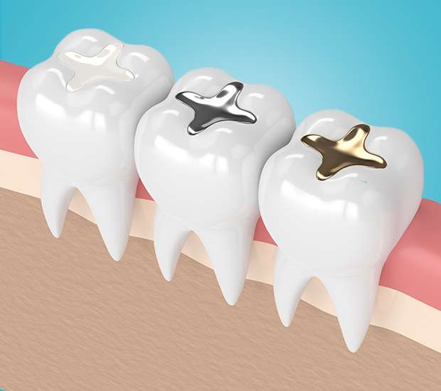 Fontana Composite Fillings