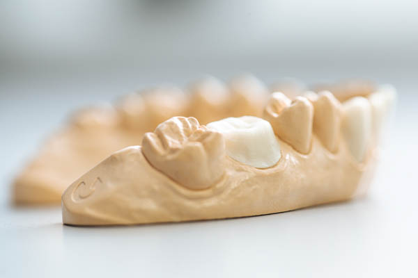 The Steps Of A Dental Crown Restoration