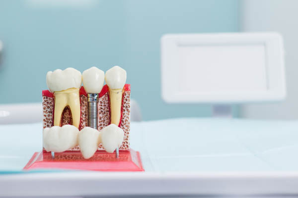 Consider Dental Implants For Replacing A Missing Tooth