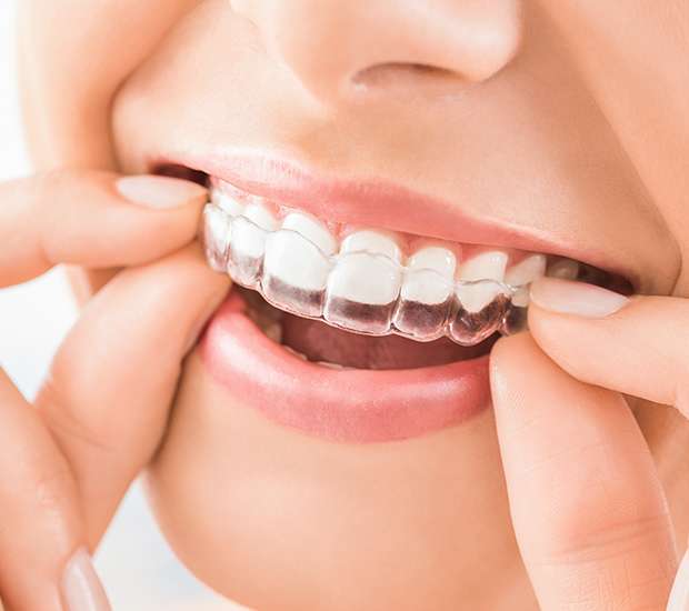 Fontana Does Invisalign Really Work